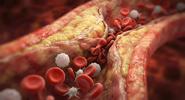 Atherosclerosis and blood clot formation in an artery, a medical